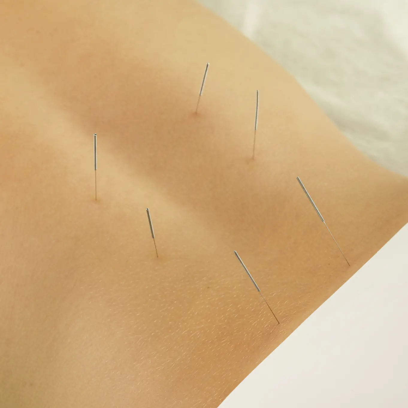 Foto de la página web de Noboli para la sección de acupuntura. Una persona haciéndose acupuntura.