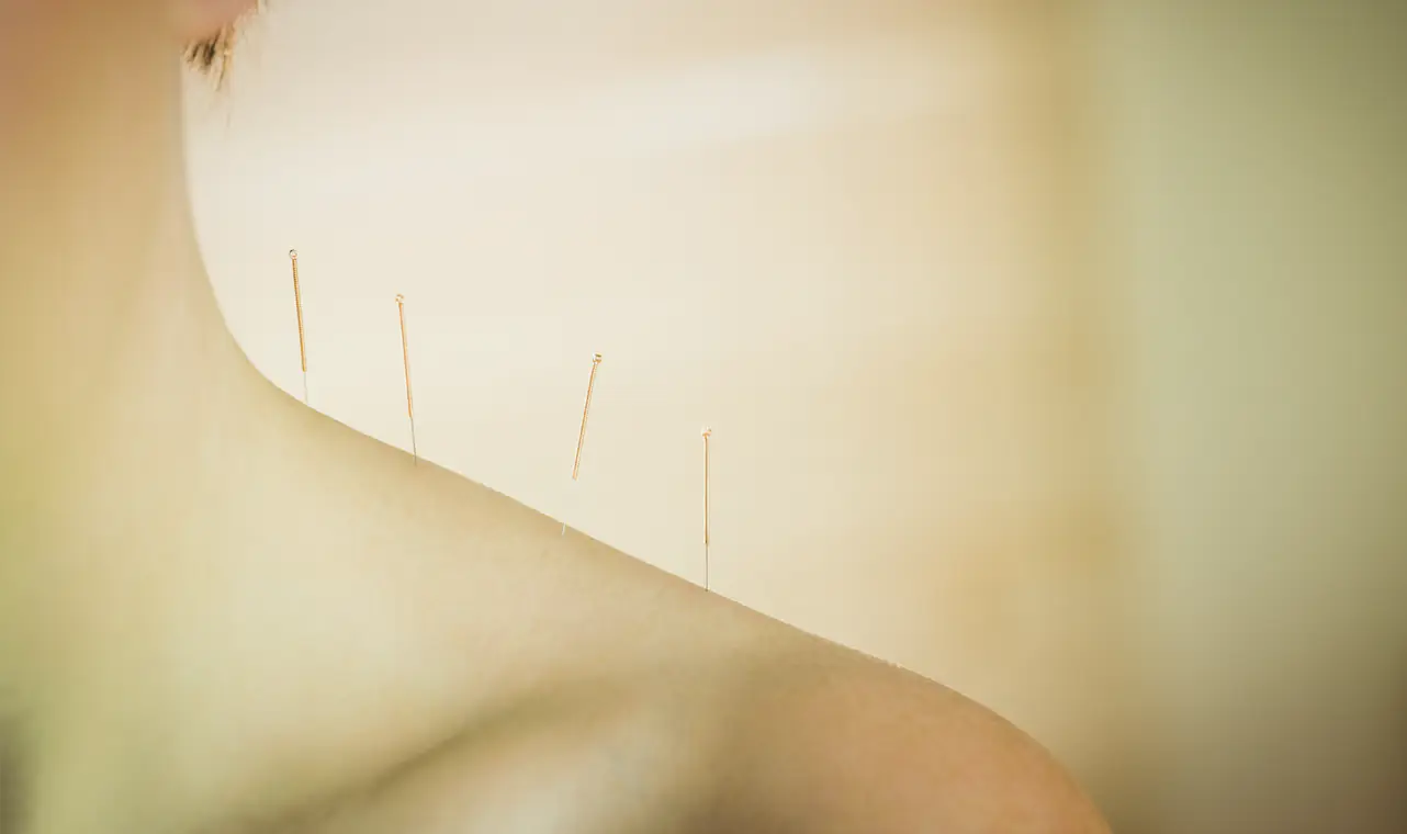 Foto de la página web de Noboli para la sección de acupuntura. Una persona haciéndose acupuntura.