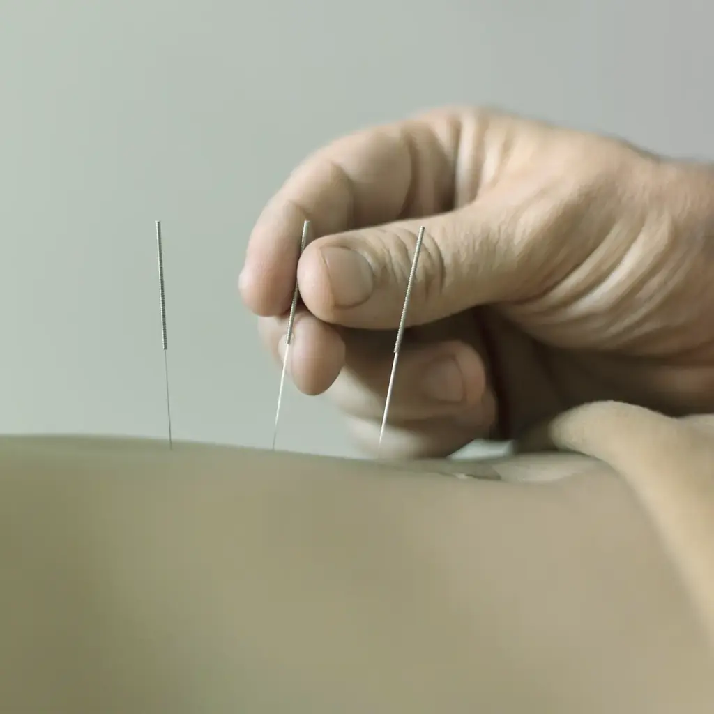 Foto de la página web de Noboli para la sección salud. Una sesión de acupuntura.